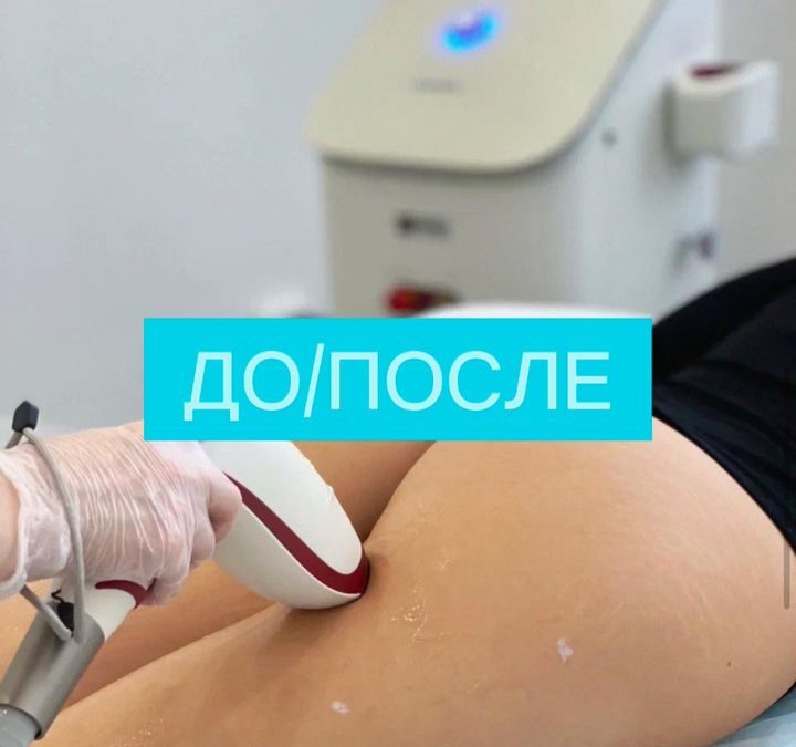 Лазерная эпиляция ДО/ПОСЛЕ